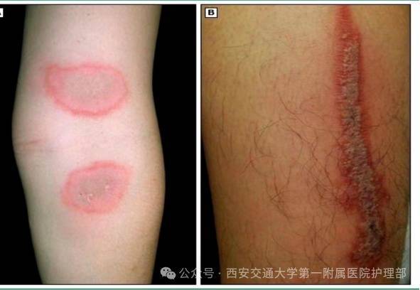 西安多区发现隐翅虫？千万别拍！毒液堪比硫酸